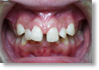 出っ歯症例2